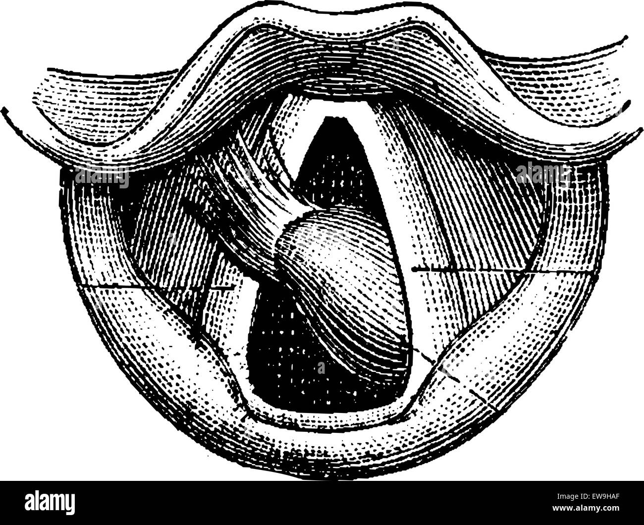 Fibroma of the Larynx, vintage engraved illustration. Usual Medicine Dictionary by Dr Labarthe - 1885 Stock Vector