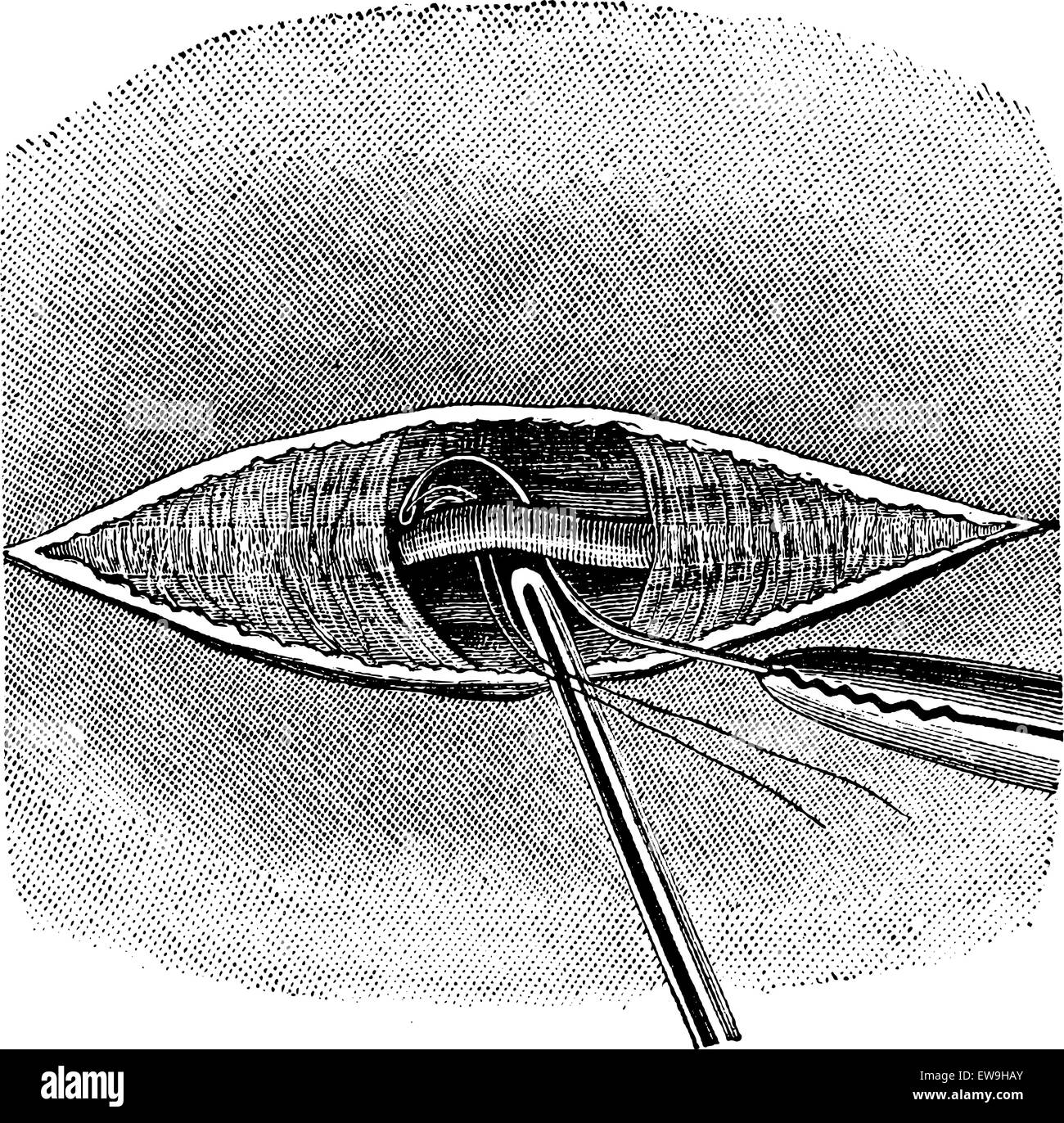 Placement of the wire ligature with a needle deschamps, fluted probe