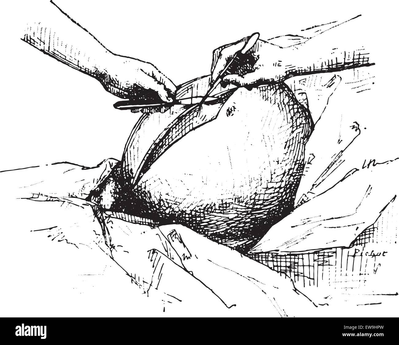 Abdominal incision High Resolution Stock Photography and Images - Alamy