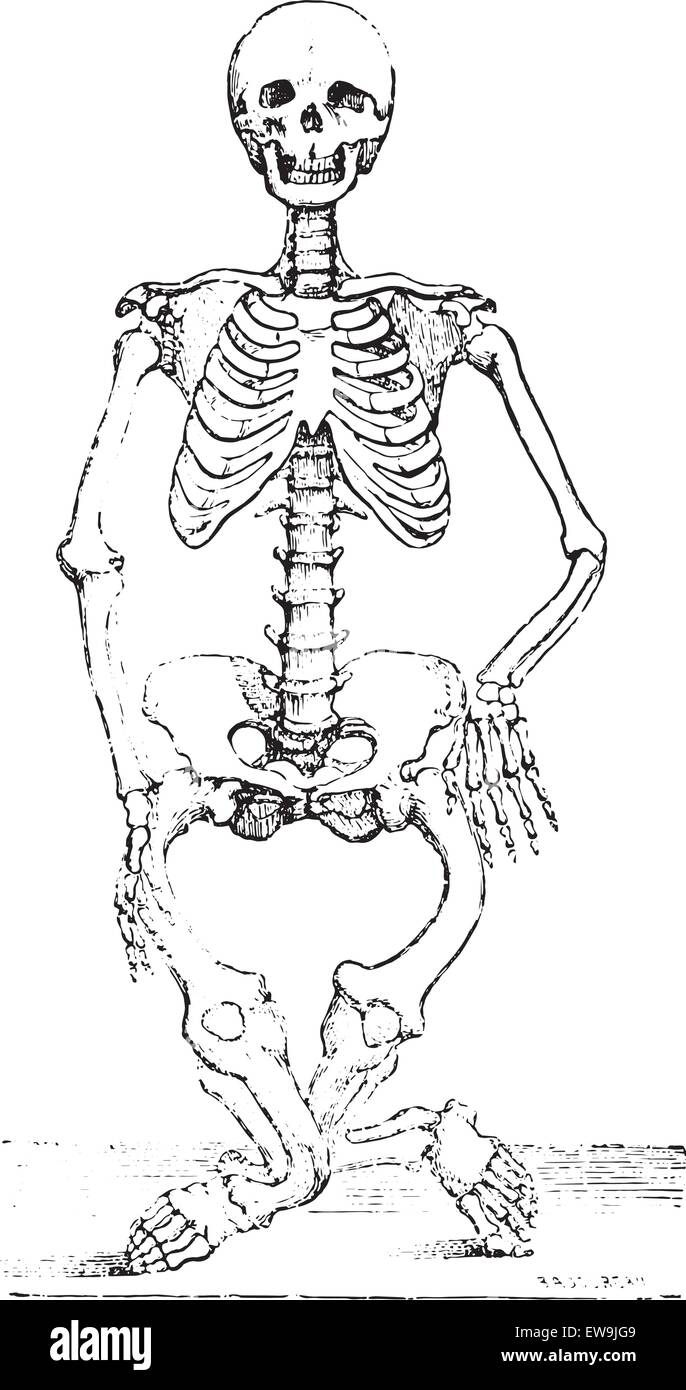 Skeleton deformed by rickets, vintage engraved illustration. Usual Medicine Dictionary by Dr Labarthe - 1885. Stock Vector