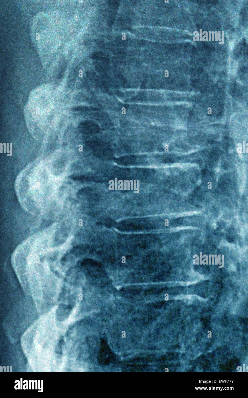 VERTEBRAL OSTEOARTHRITIS, XRAY Stock Photo Alamy