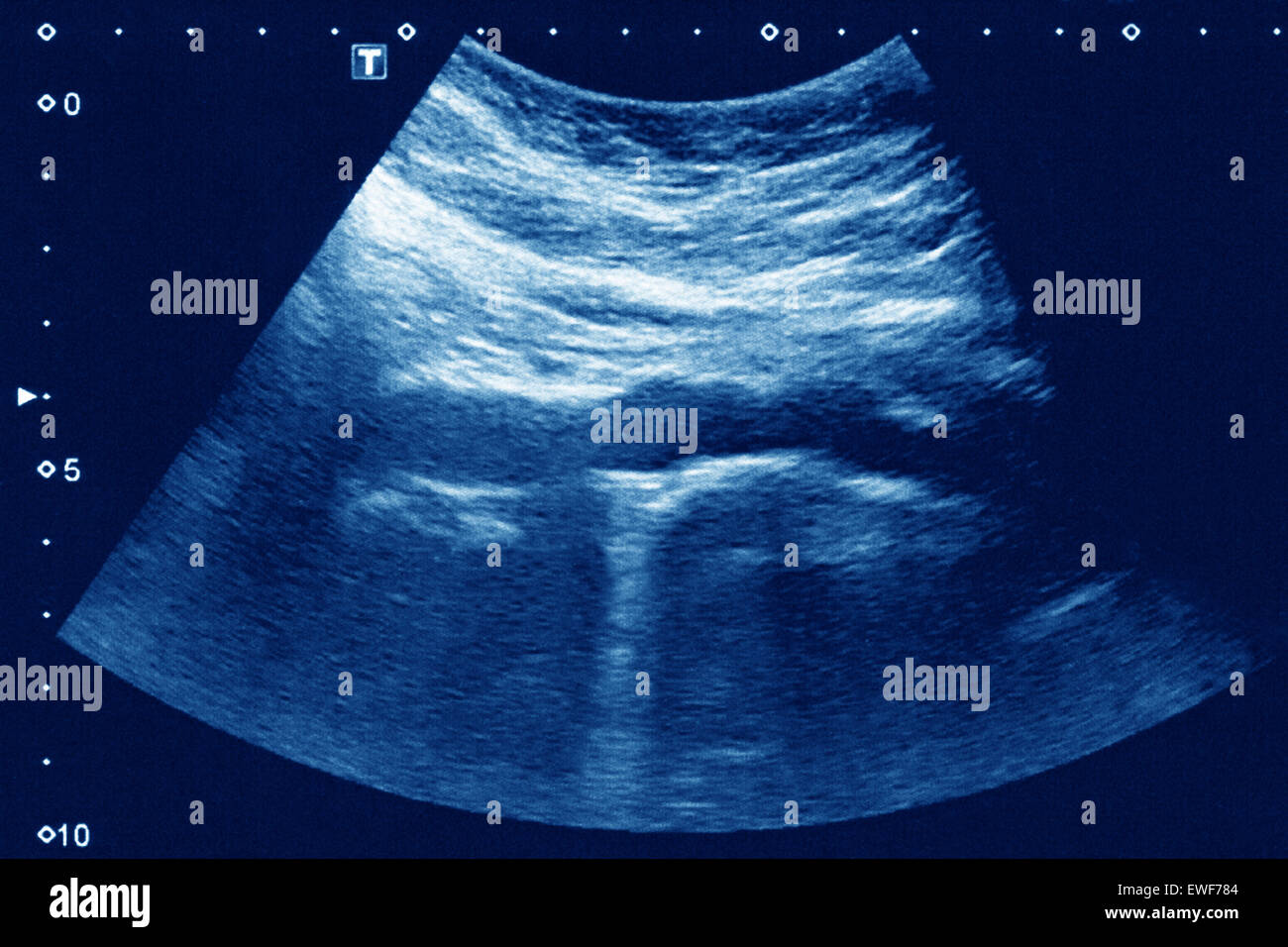 Aorta Plaque Ultrasound