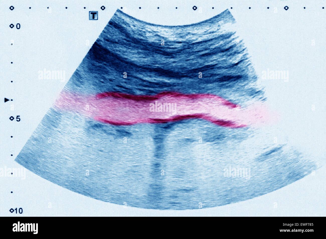 ATHEROMATOUS AORTA, SONOGRAPHY Stock Photo