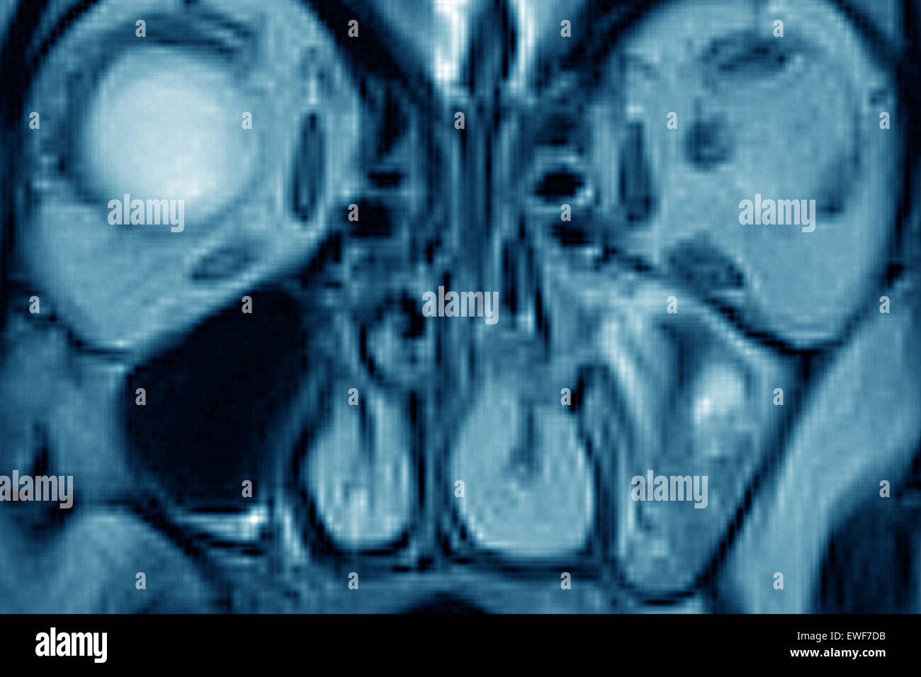 SINUSITIS MRI Stock Photo