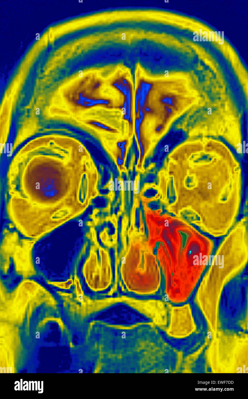 SINUSITIS MRI Stock Photo