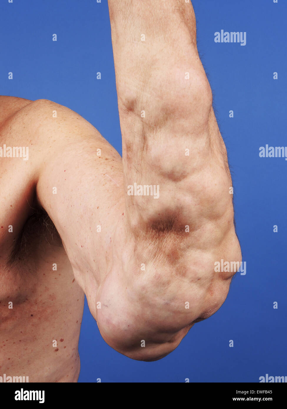 LIPOMA Stock Photo