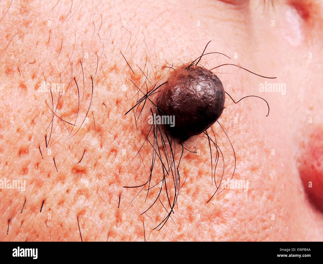 hairy nevus surgery