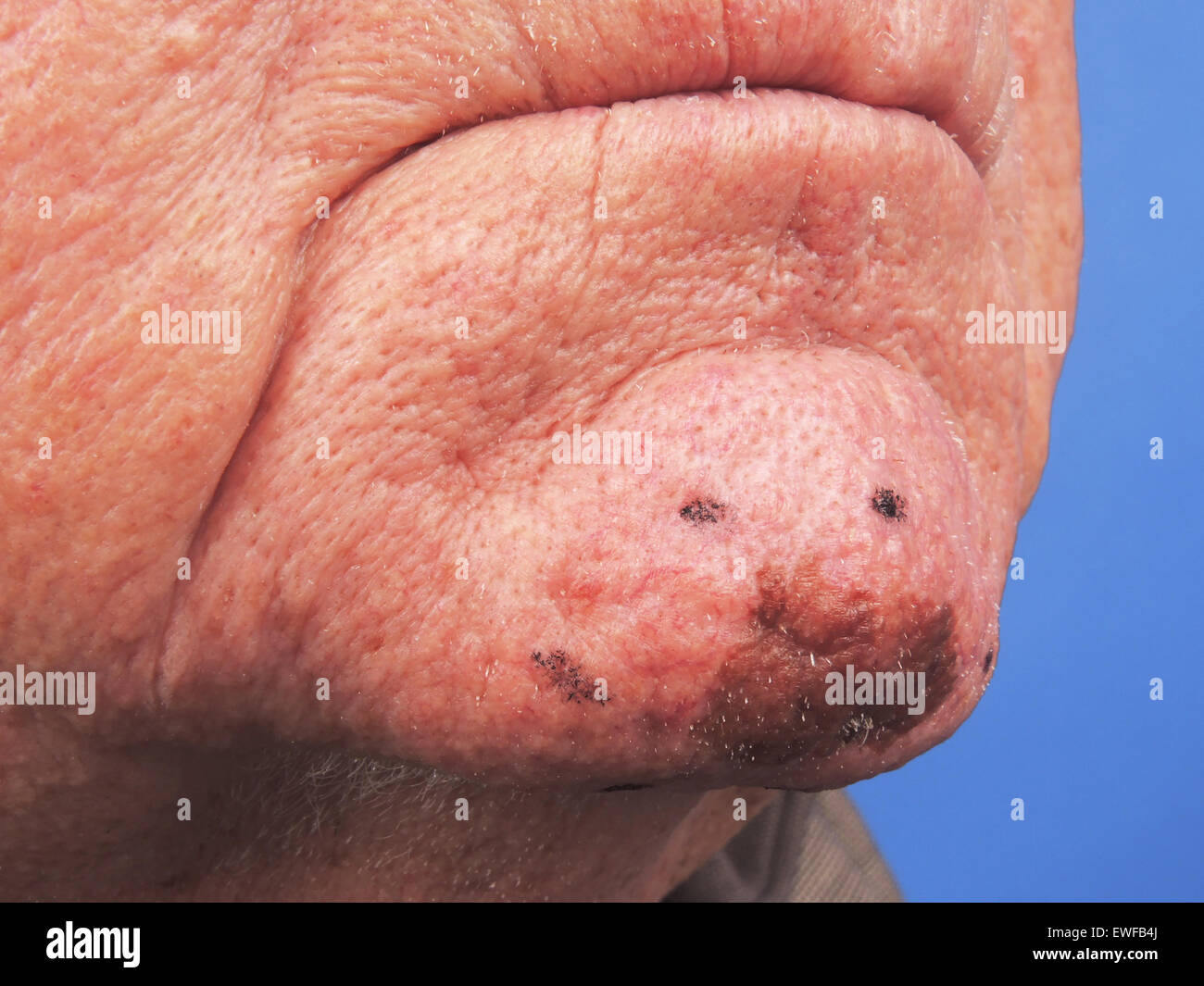 lipo c with b12 with tirzepatide Melanoma: current perspectives on diagnosis and management main image 0