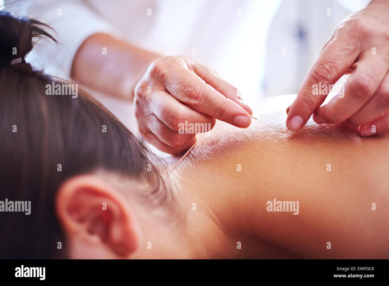 Close up acupuncturist applying acupuncture needles to woman’s neck Stock Photo