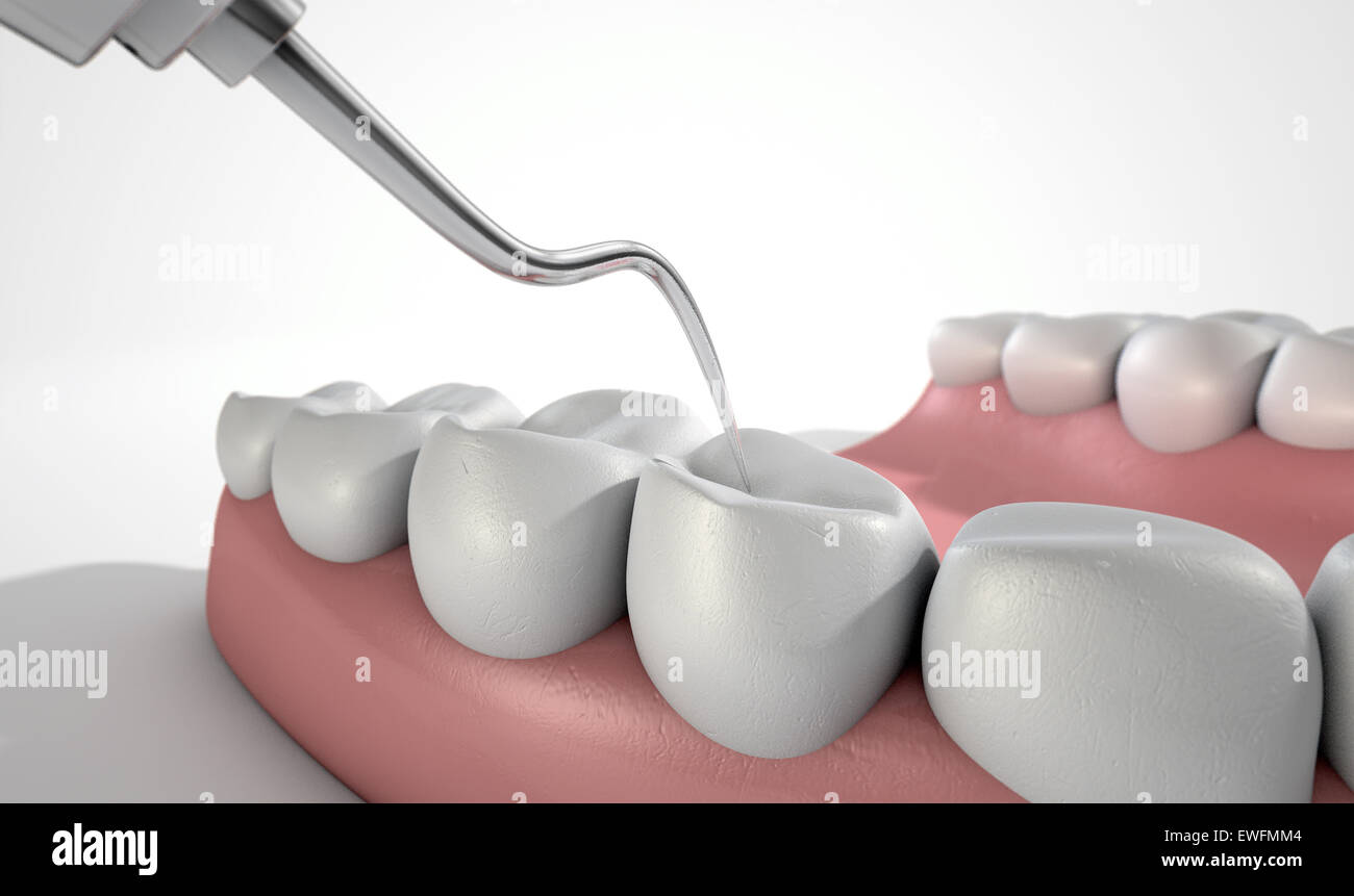 A closeup of a steel dentists hook probe performing an examination on a