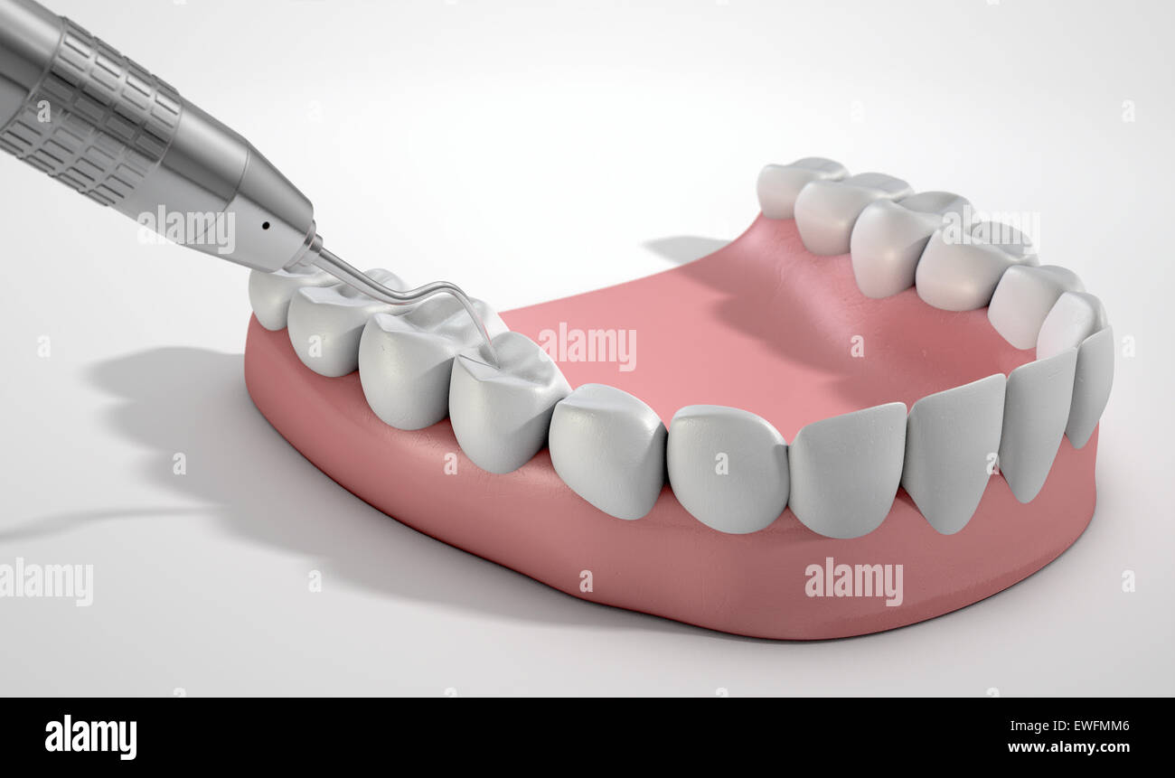 A closeup of a steel dentists hook probe performing an examination on a