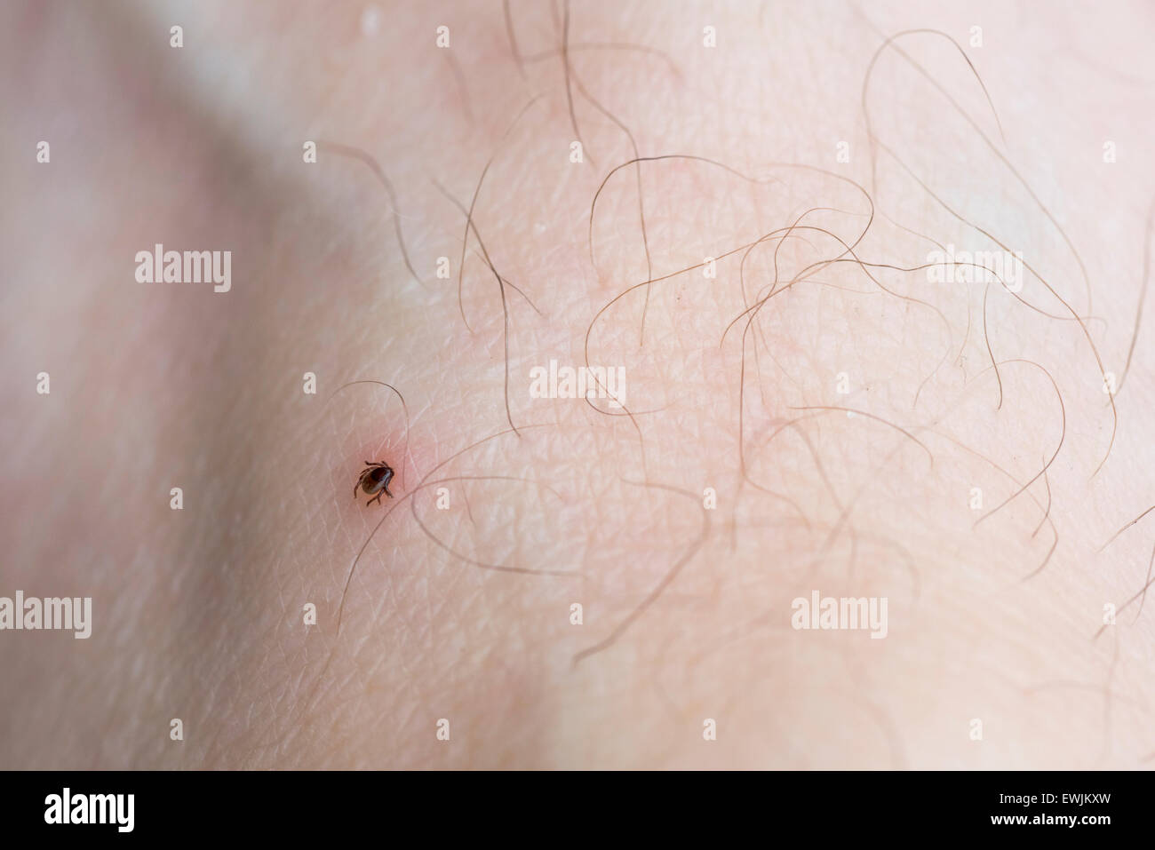 The deer or sheep tick that has attached itself to the photographer's foot Stock Photo