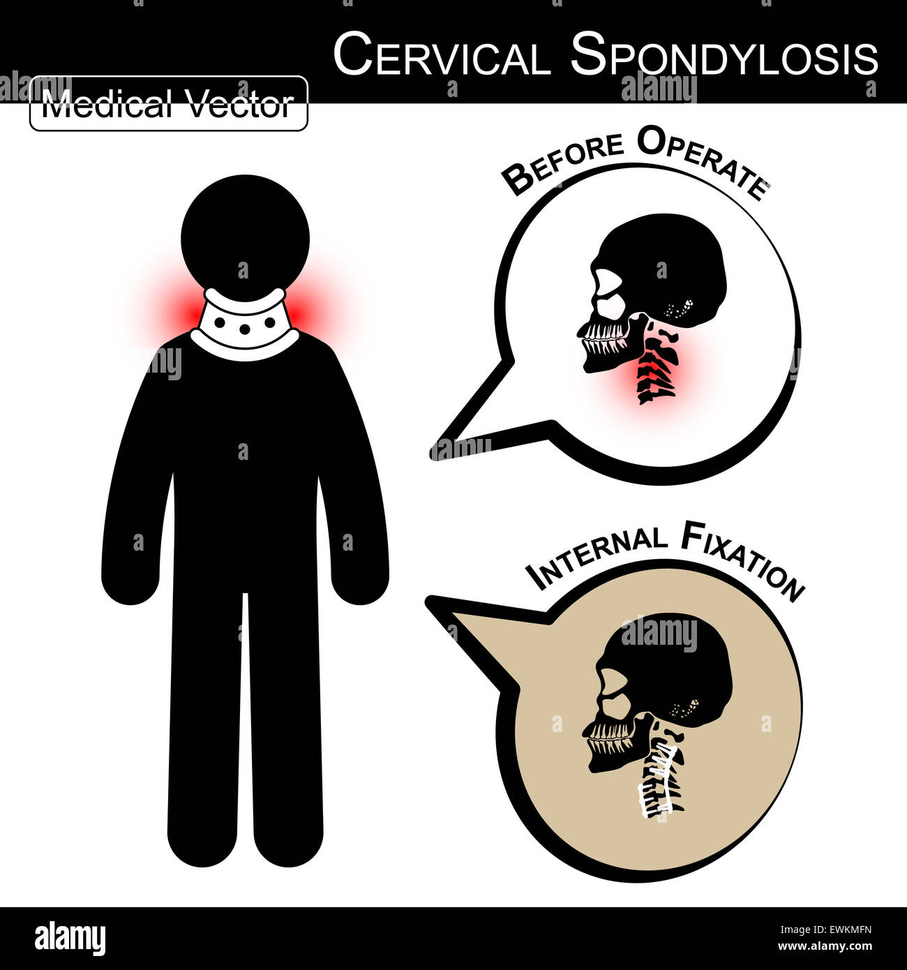 Stick man with hard collar ( Cervical spondylosis ) and bubble ( Before operate , After operate internal fixation by plate and s Stock Photo