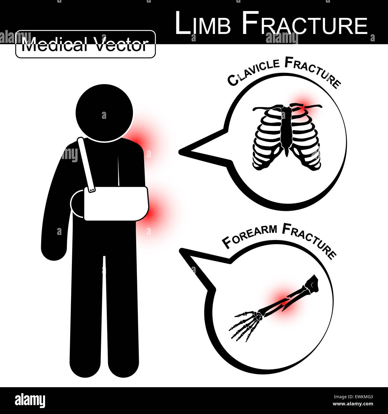 Stick man with armsling ( clavicle and forearm fracture ) and text bubble  ( Medical , Health , Healthcare vector ) Stock Photo