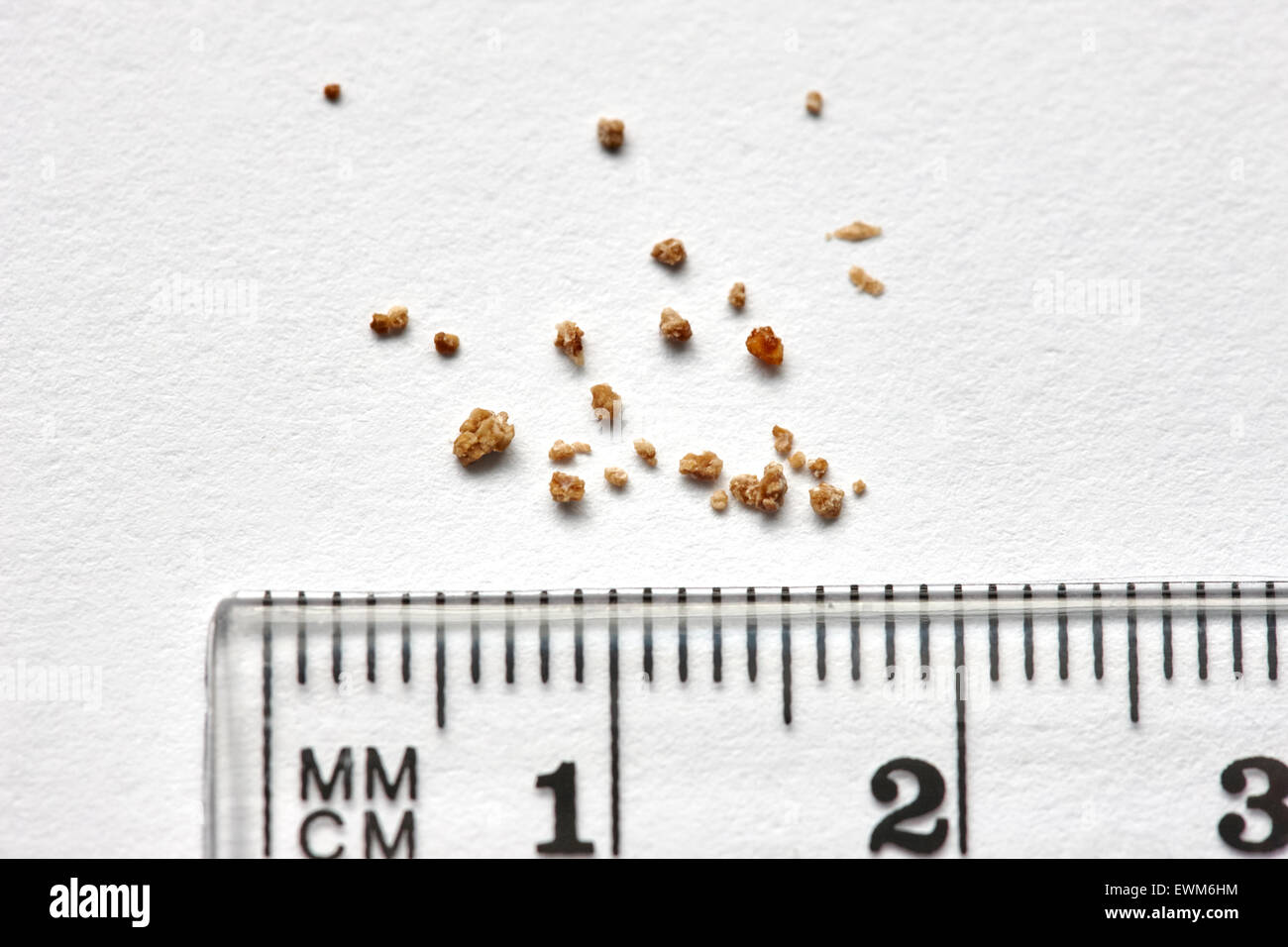 fragments of a kidney stone broken up by extracorporeal shock wave lithotripsy with a mm measuring scale Stock Photo