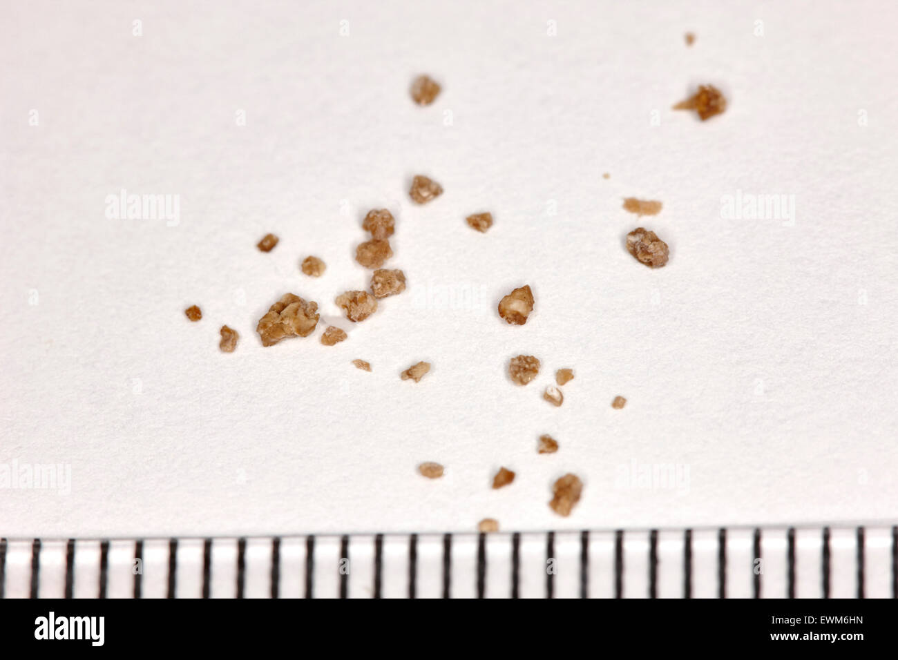 fragments of a kidney stone broken up by extracorporeal shock wave lithotripsy with a mm measuring scale Stock Photo