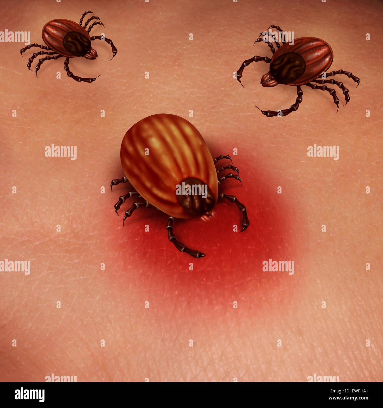 Lyme disease human tick concept as a female insect feeding for blood on the skin of a human host as a health care issue for bacterial infection and dangers of infection from ticks found in nature. Stock Photo