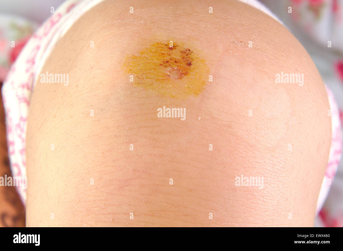 Close up view on a girl scraped knee Stock Photo Alamy