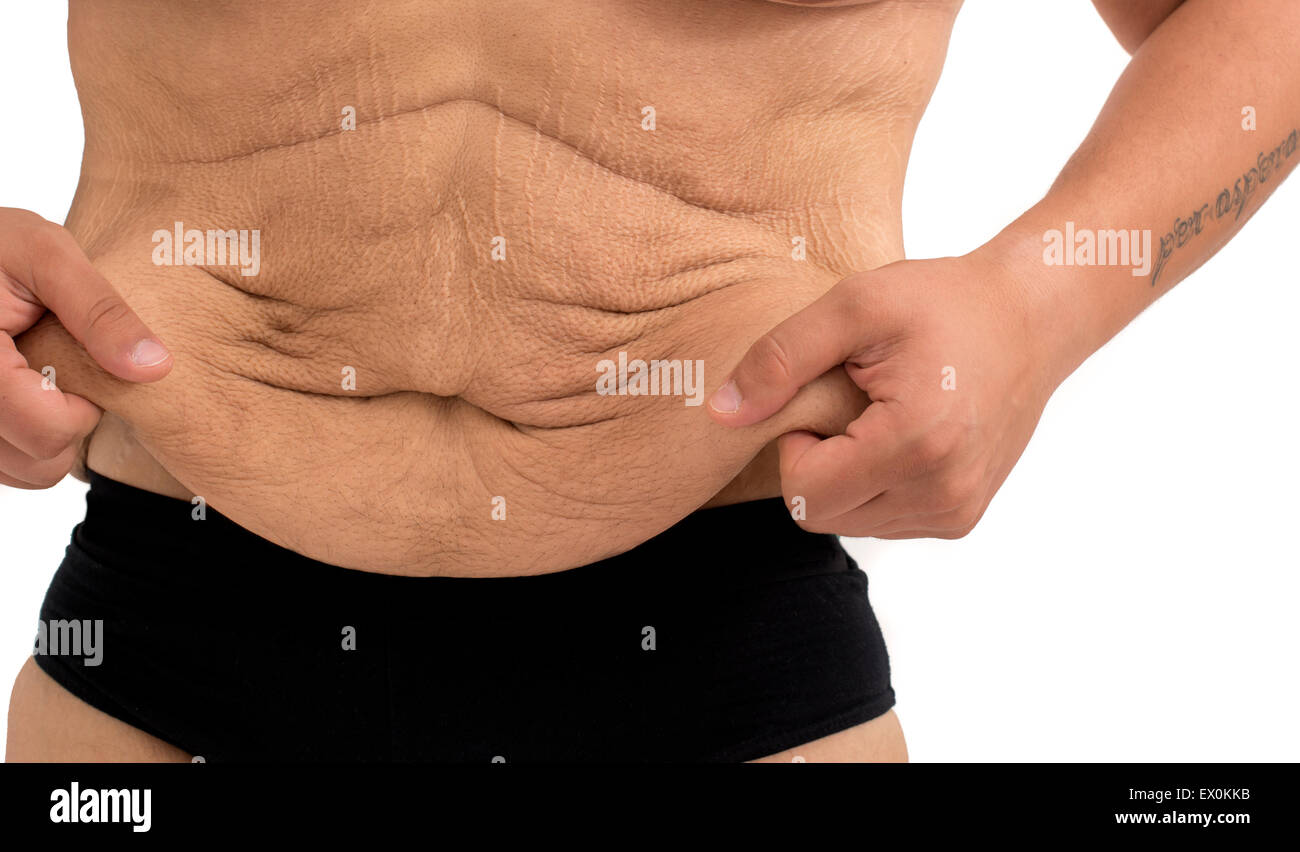 stretch marks of a man after  weight loss Stock Photo