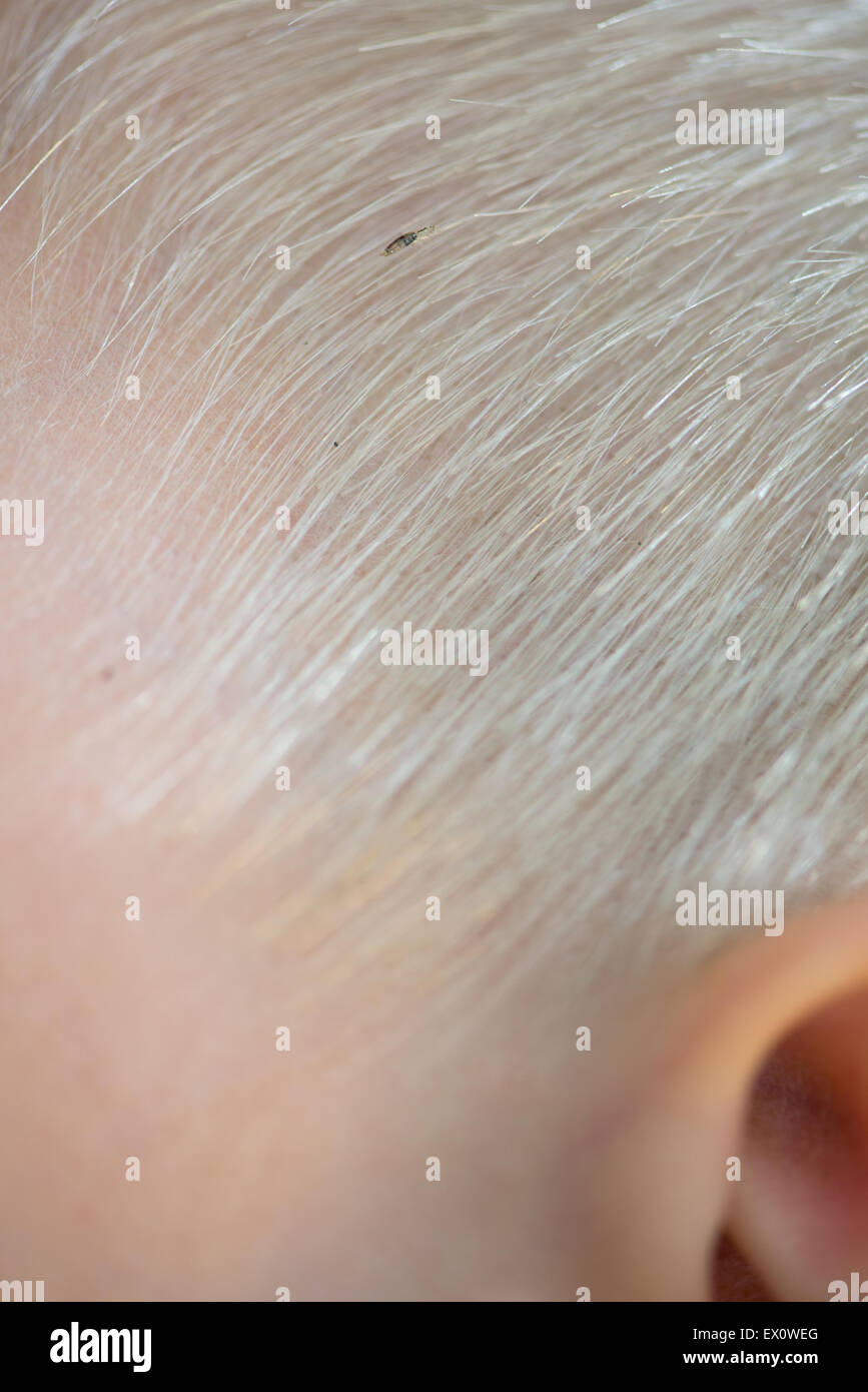 Head louse, insect, on head and on blond hair Stock Photo - Alamy