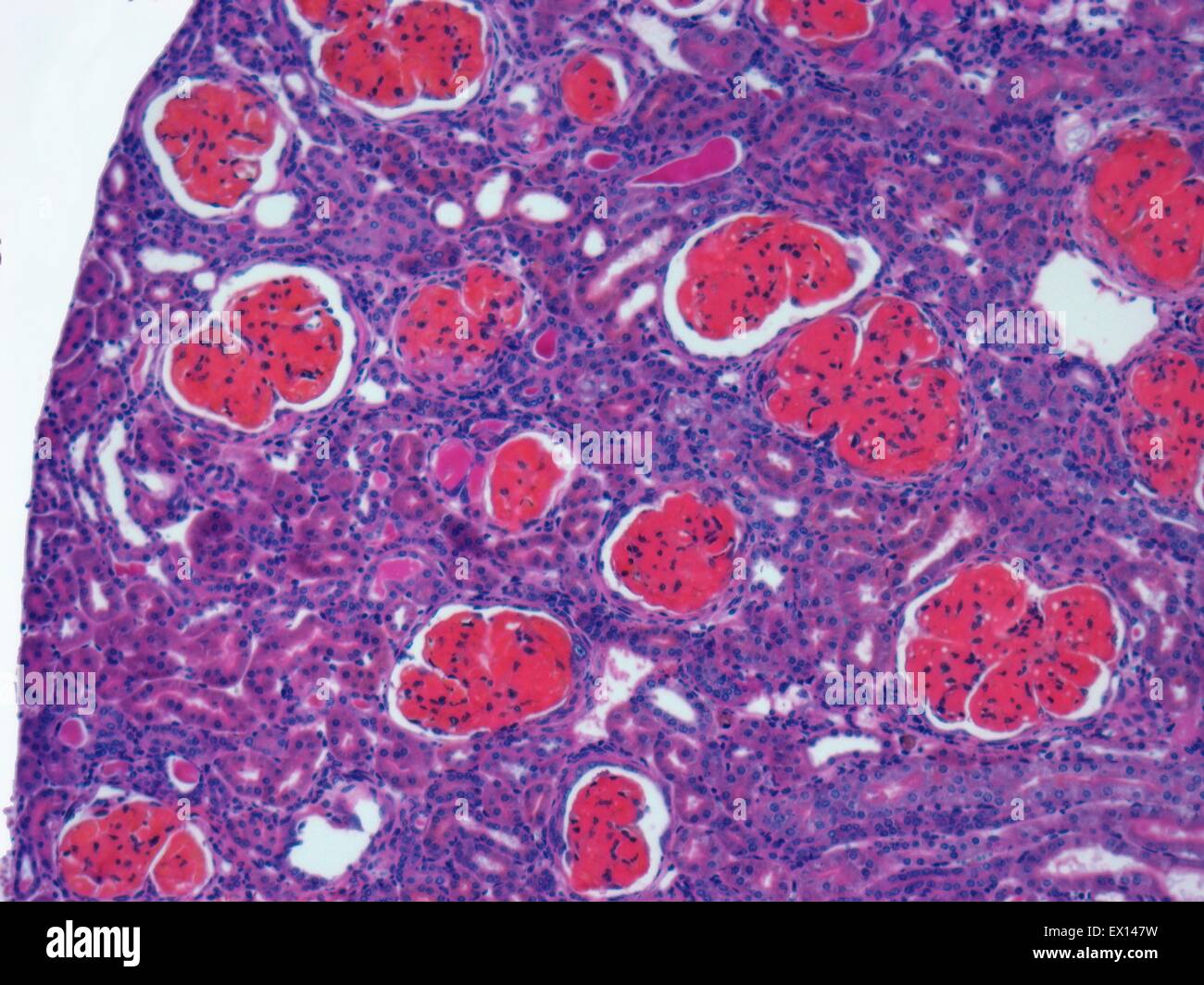 Glomerulonephritis Light micrograph of tissue from a kidney in a case of glomerulonephritis This condition refers to Stock Photo