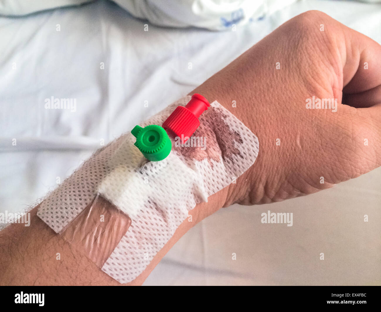Intravenous cannula, venflon inserted on man's hand with bloodstain. Stock Photo
