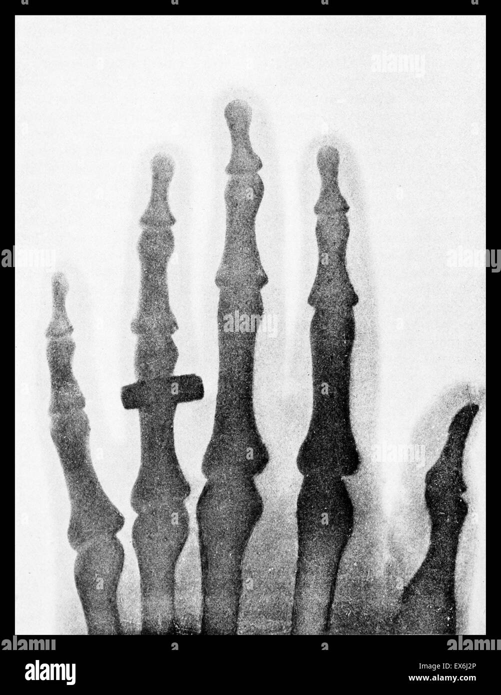 The hand of Mrs. Wilhelm Roentgen: the first X-ray image, 1895 Stock Photo