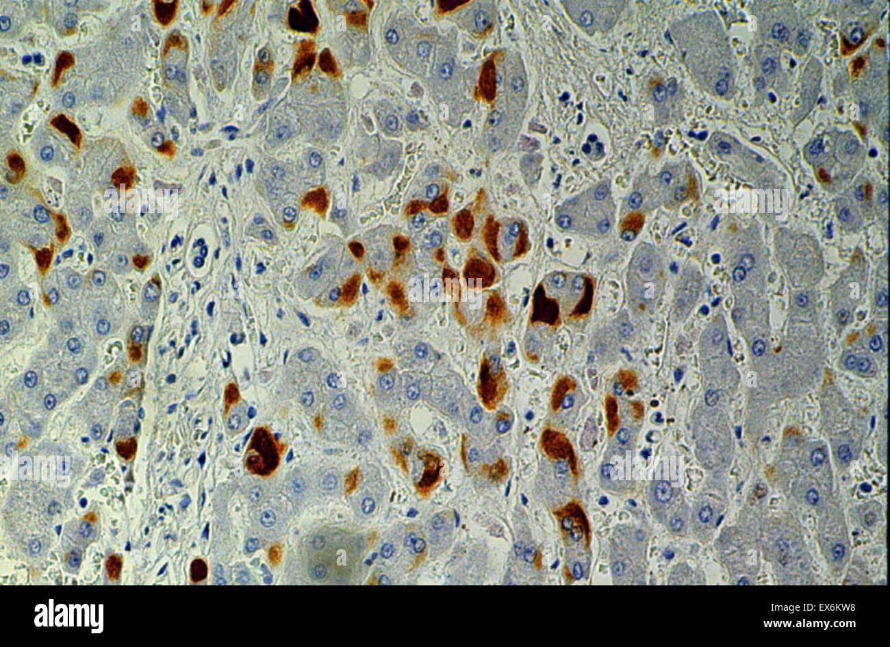 Hepatitis B Surface Antigen: Immunoperoxidase staining of formalin-fixed, paraffin-embedded, mouse liver showing cytoplasm staining of hepatocytes Stock Photo