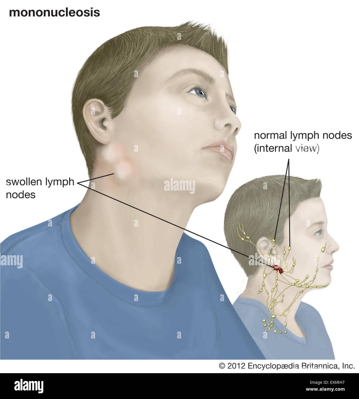 Glandular fever hires stock photography and images Alamy