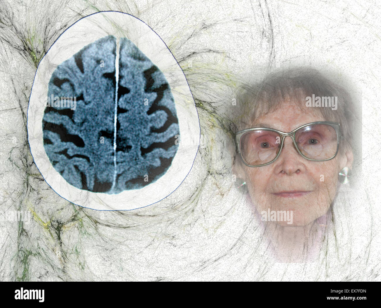 CT scan of an 84 yo male with Alzheimer's disease. CT shows brain