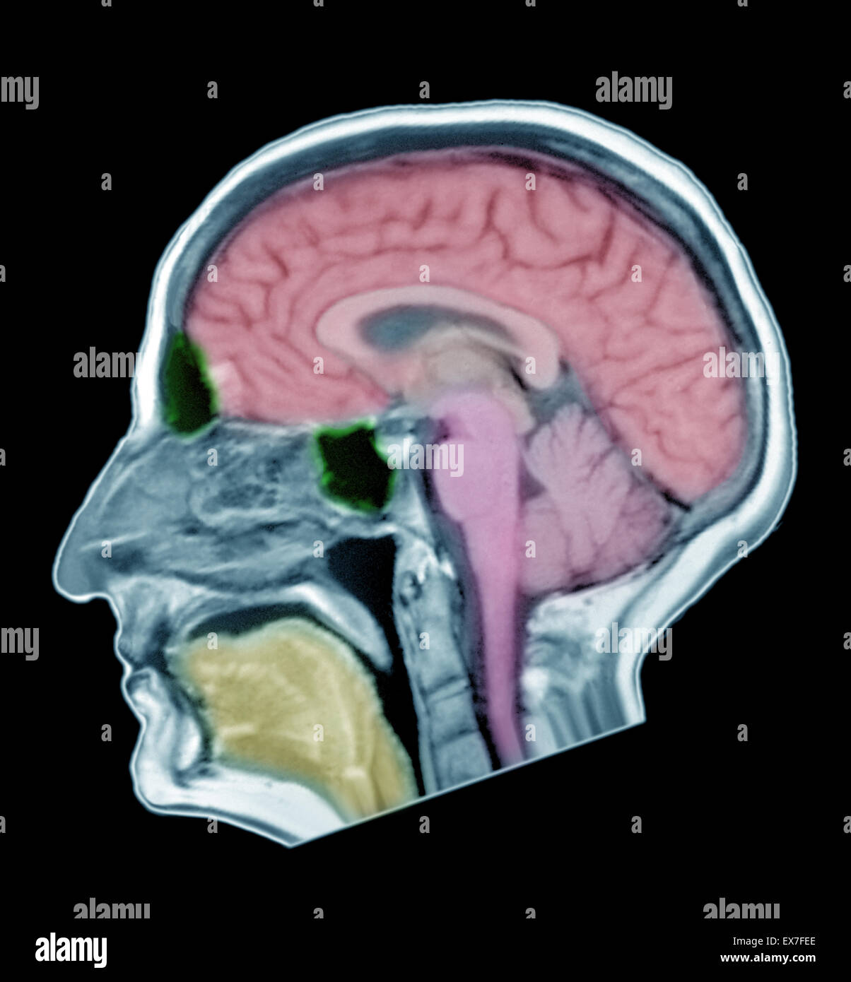 Brain MRI of adult male, normal structures. Stock Photo