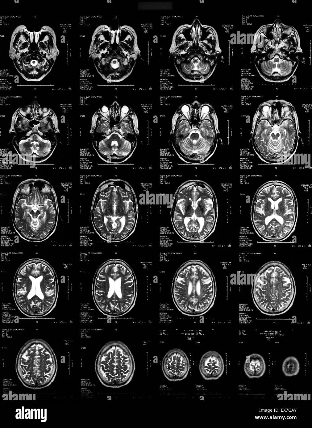 Normal MRI of the brain of a 62 year old woman. Stock Photo