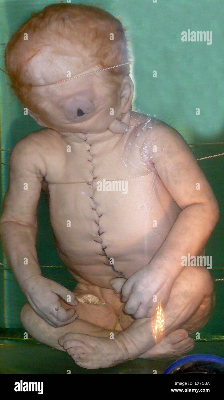 Cyclopia in human. Photo of a visiting exhibit from St. Petersburg's Kunstkamera ('Cabinet of Curiosities'). Stock Photo