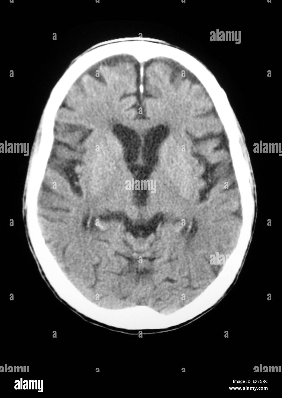 CT scan of an 84 year old man with Alzheimer's disease.  CT shows brain atrophy. Stock Photo