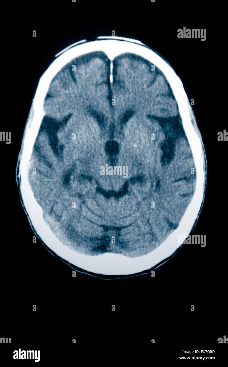 CT scan of an 84 year old man with Alzheimer's disease.  CT shows brain atrophy. Stock Photo