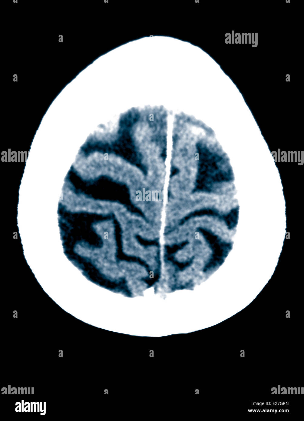Alzheimer disease brain hi-res stock photography and images - Alamy