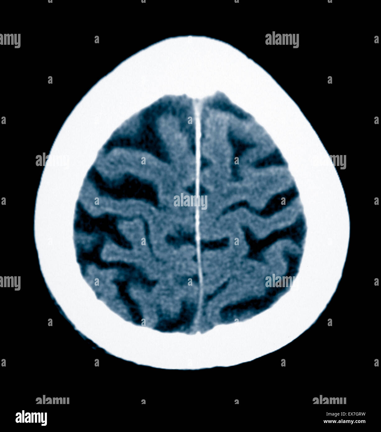CT scan of an 84 year old man with Alzheimer's disease. CT ...