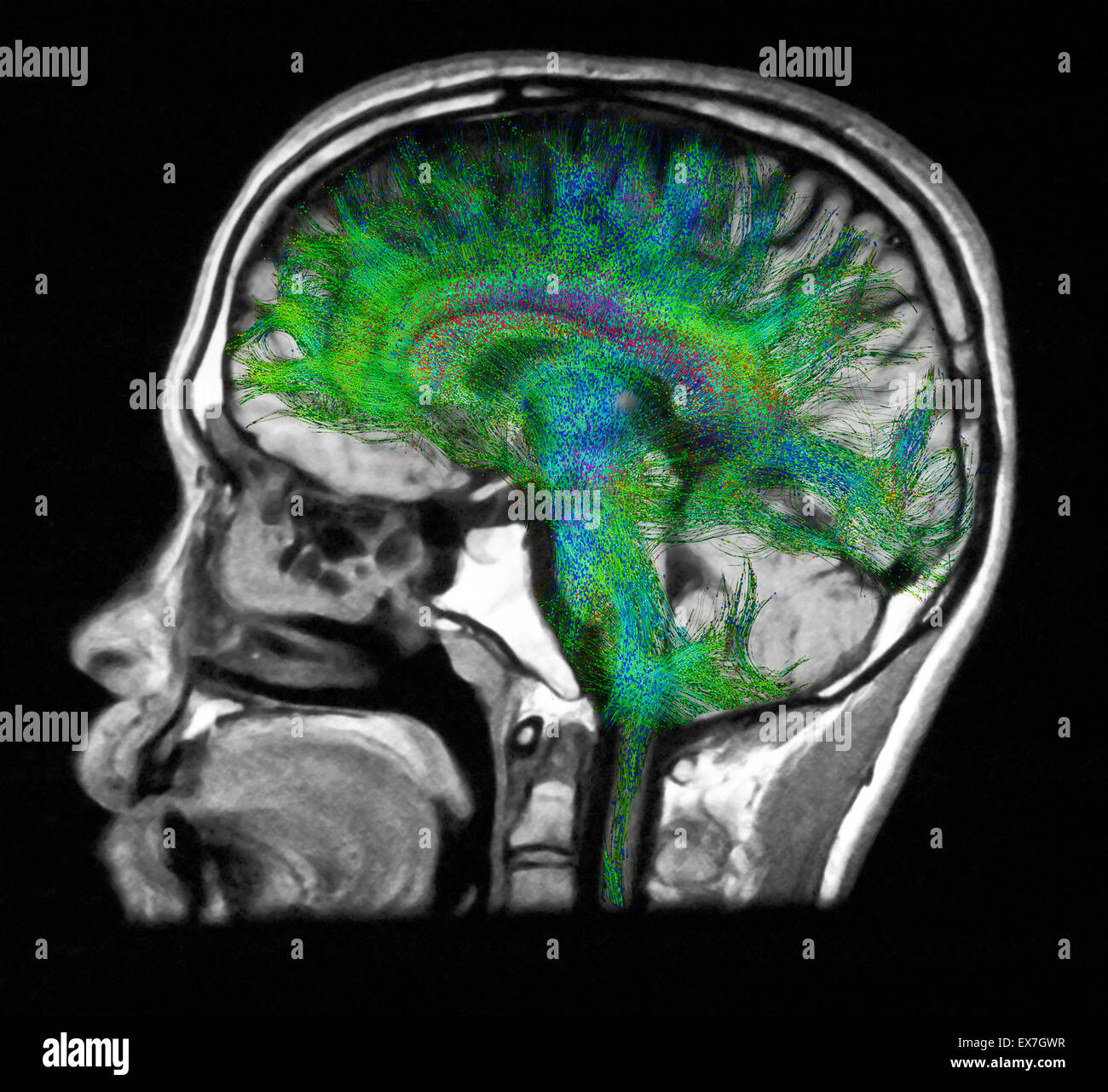 Diffusion MRI tractography of the human brain superimposed over an MRI image. Stock Photo