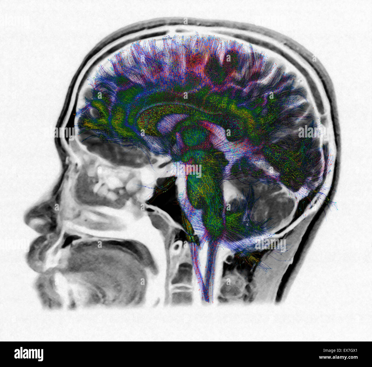 Diffusion MRI tractography of the human brain superimposed over an MRI image. Stock Photo