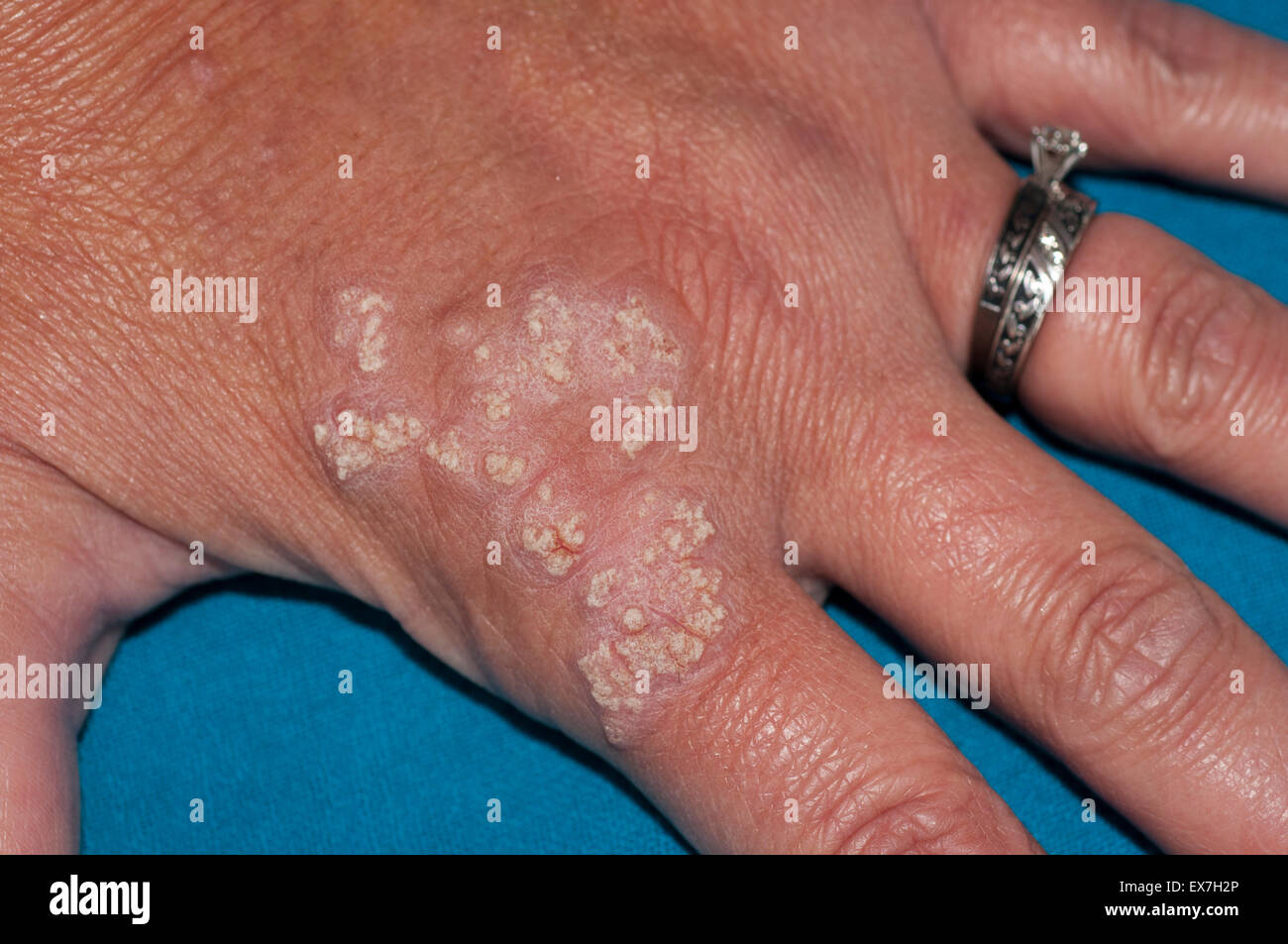 Hand lesions showing inflammatory linear verrucous epidermal nevus Stock Photo