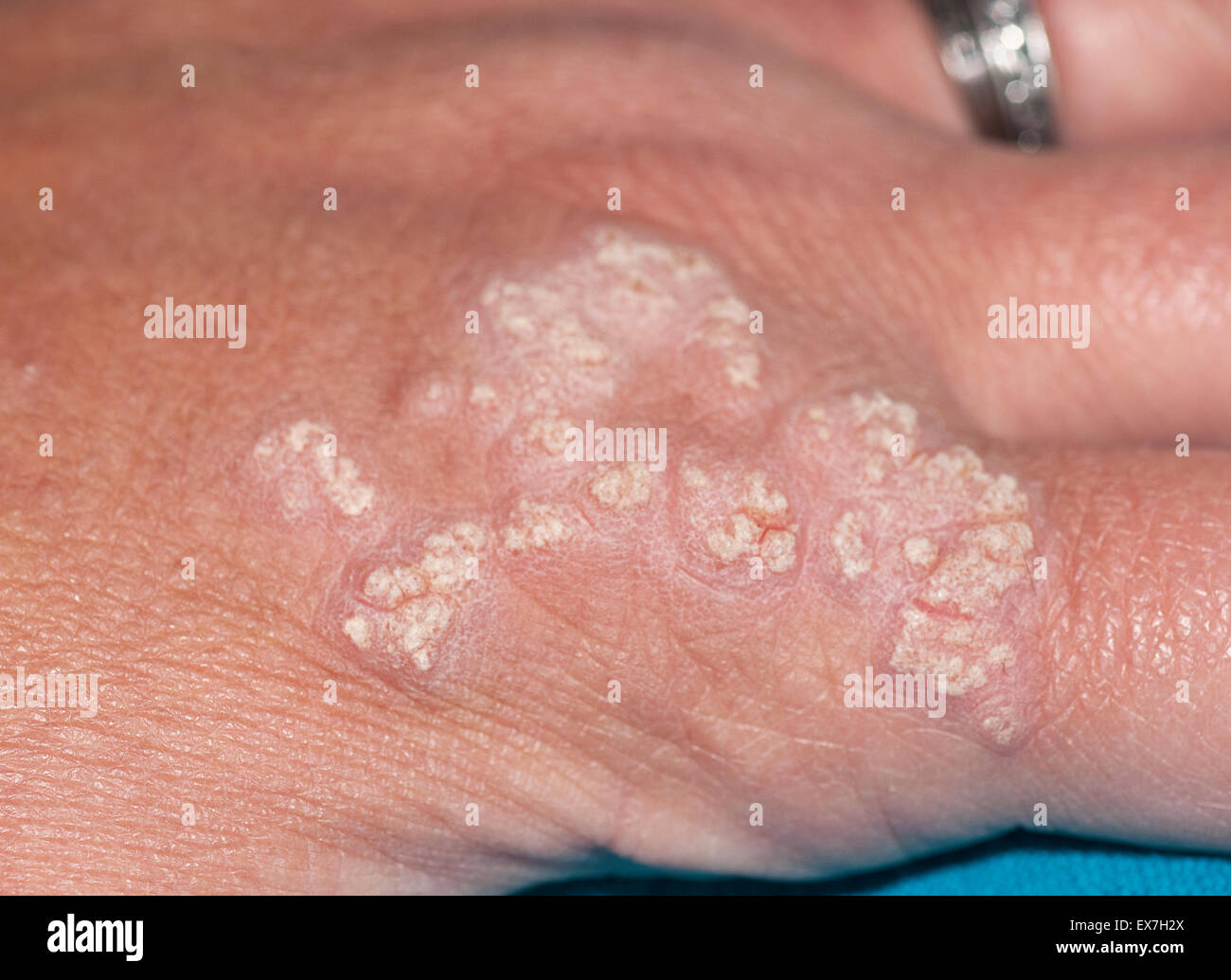 Hand lesions showing inflammatory linear verrucous epidermal nevus Stock Photo