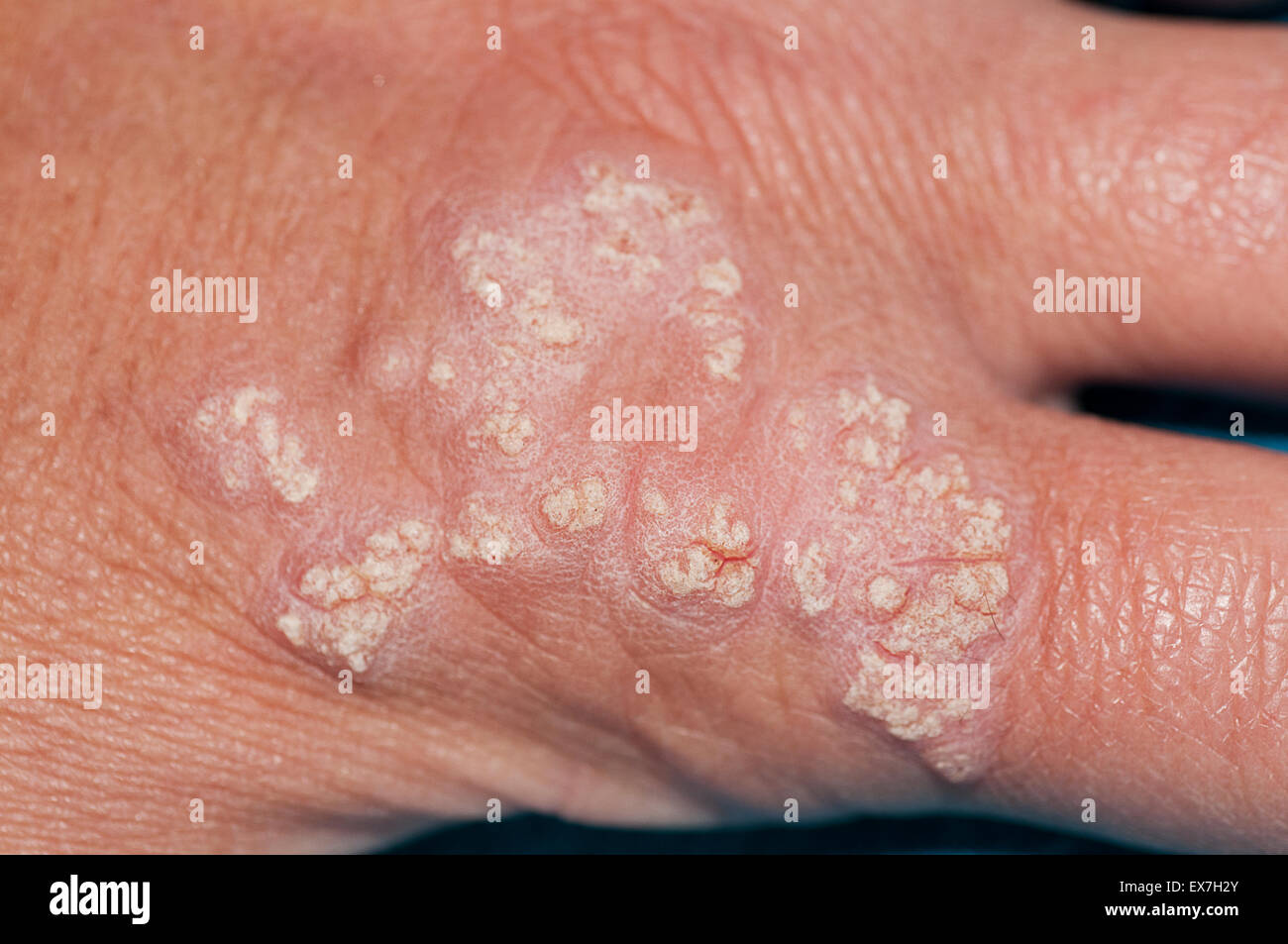 Hand lesions showing inflammatory linear verrucous epidermal nevus Stock Photo