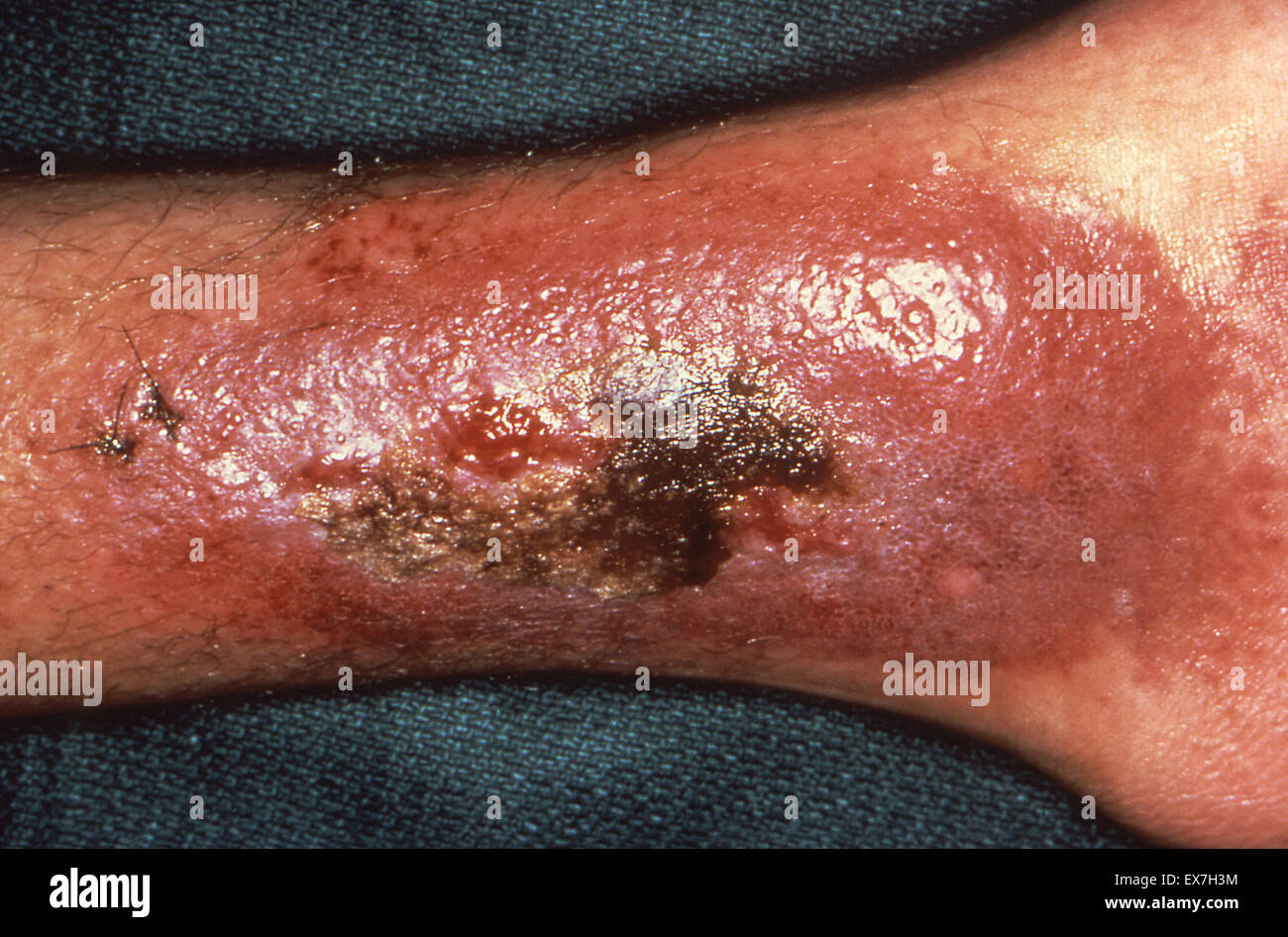 Distal leg and ankle showing a Kaposi’s sarcoma (KS) cutaneous lesion. Stock Photo