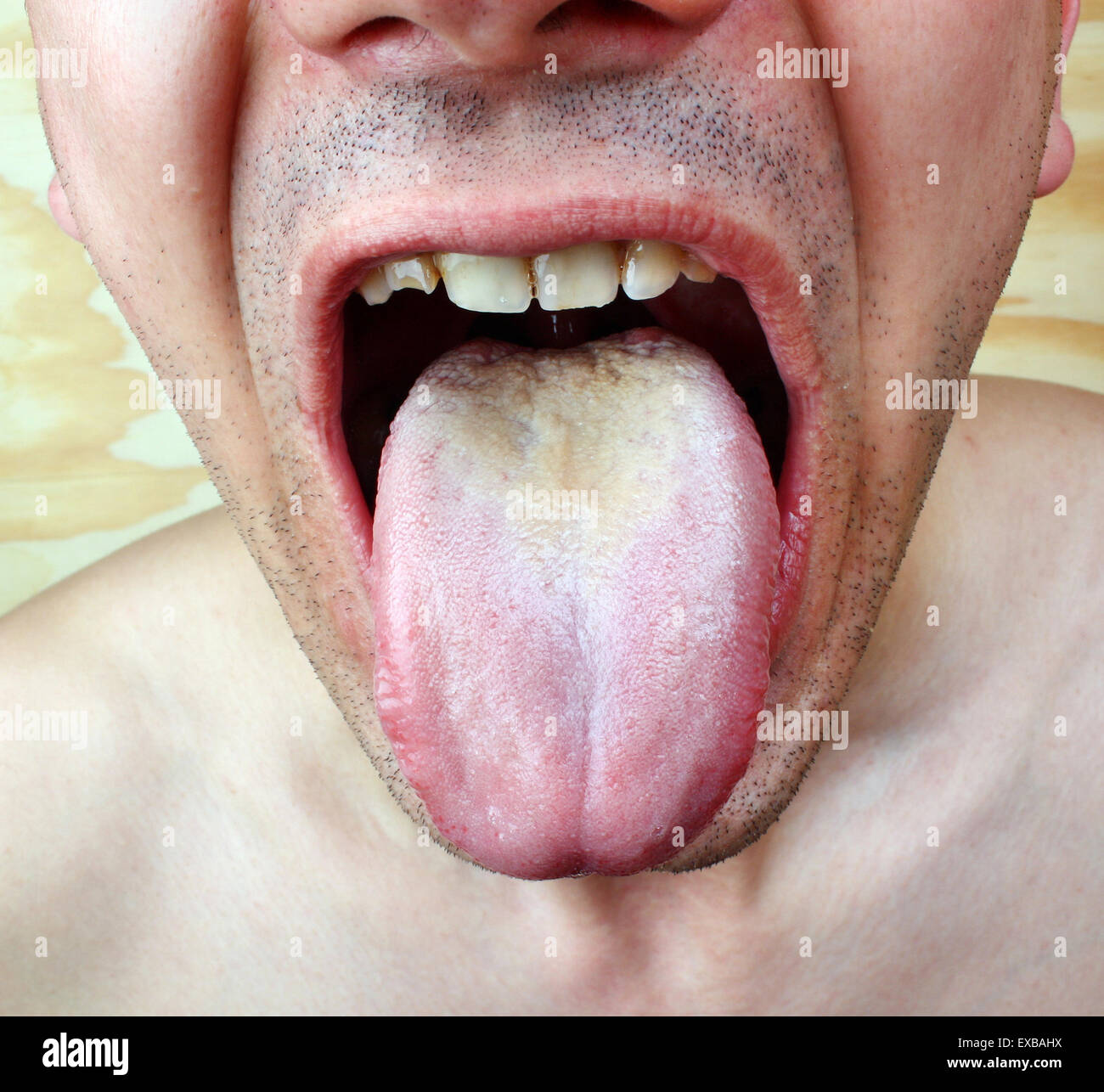 Infection tongue disease candida albicans Stock Photo