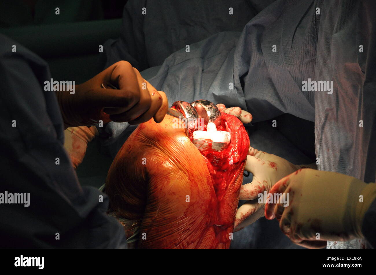 prothesis surgery An intraocular lens (or iol) is a tiny, artificial lens for the eye it replaces the eye's natural lens that is removed during cataract surgery the lens bends (refracts) light rays that enter the eye, helping you to see your lens should be clear. prothesis surgery An intraocular lens (or iol) is a tiny, artificial lens for the eye it replaces the eye's natural lens that is removed during cataract surgery the lens bends (refracts) light rays that enter the eye, helping you to see your lens should be clear.