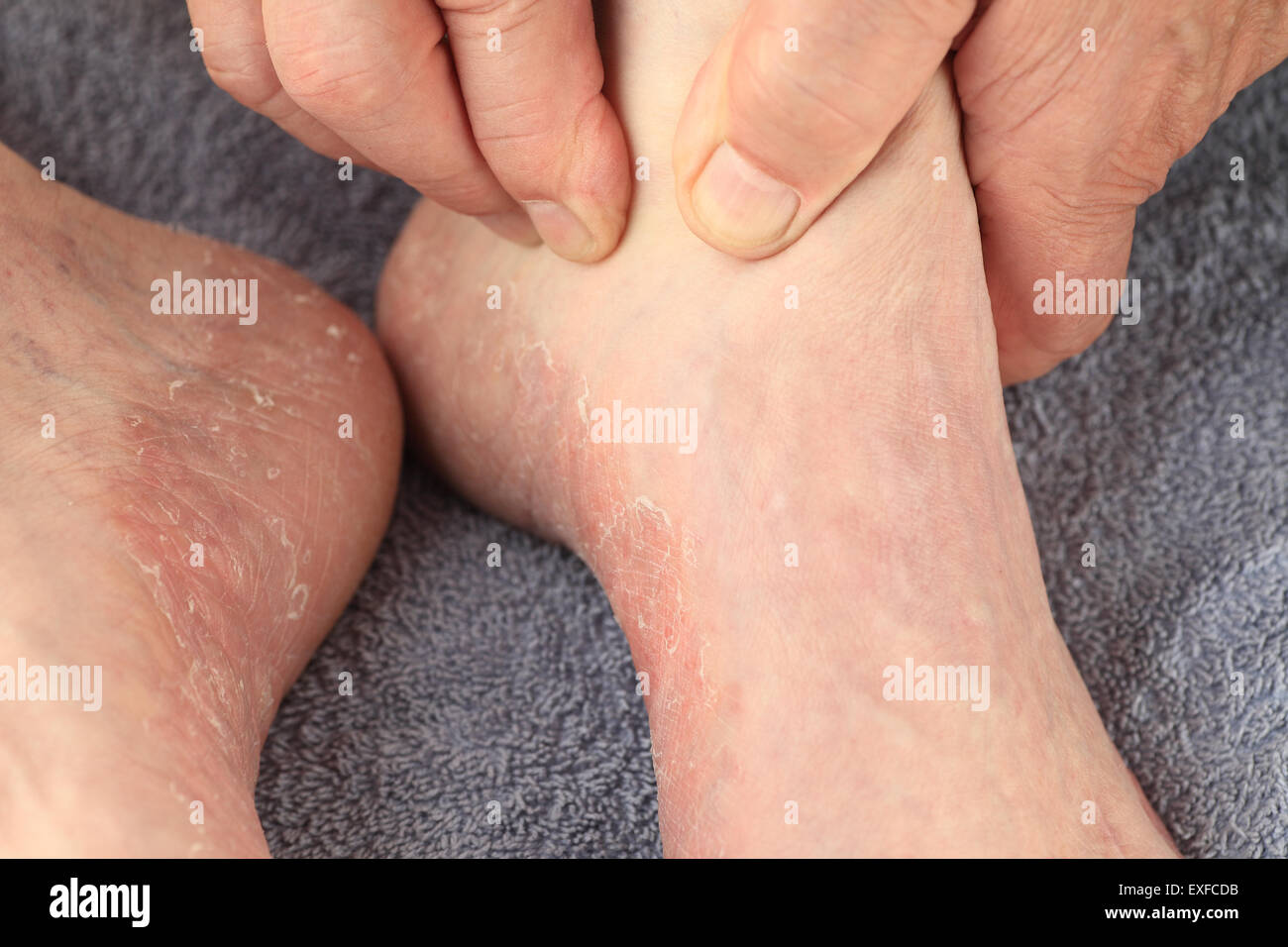 A man checks the reddened, dry skin of athletes foot on both feet. Stock Photo