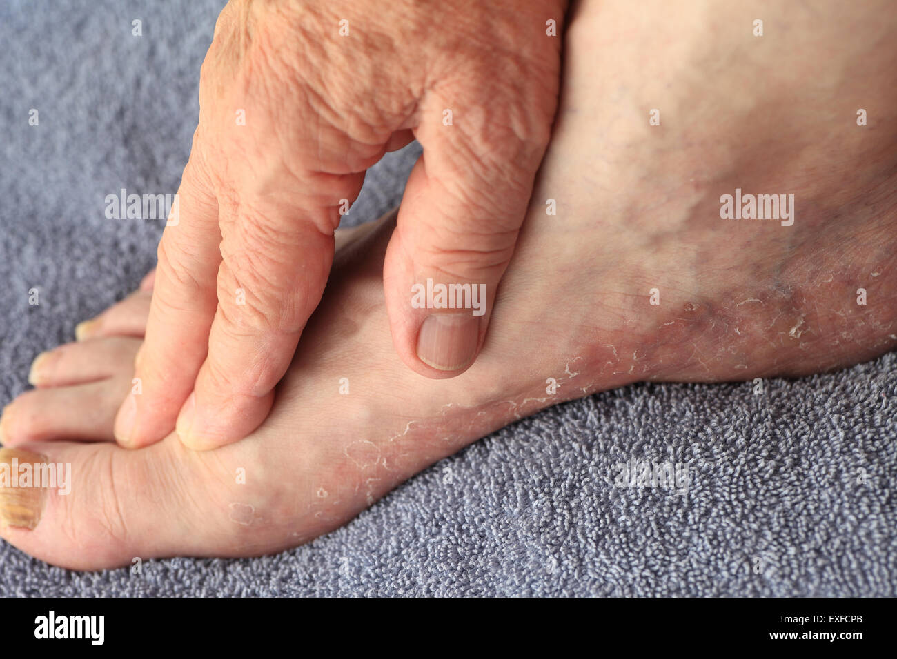 A man's foot with the dry, irritated skin of athlete's foot Stock Photo