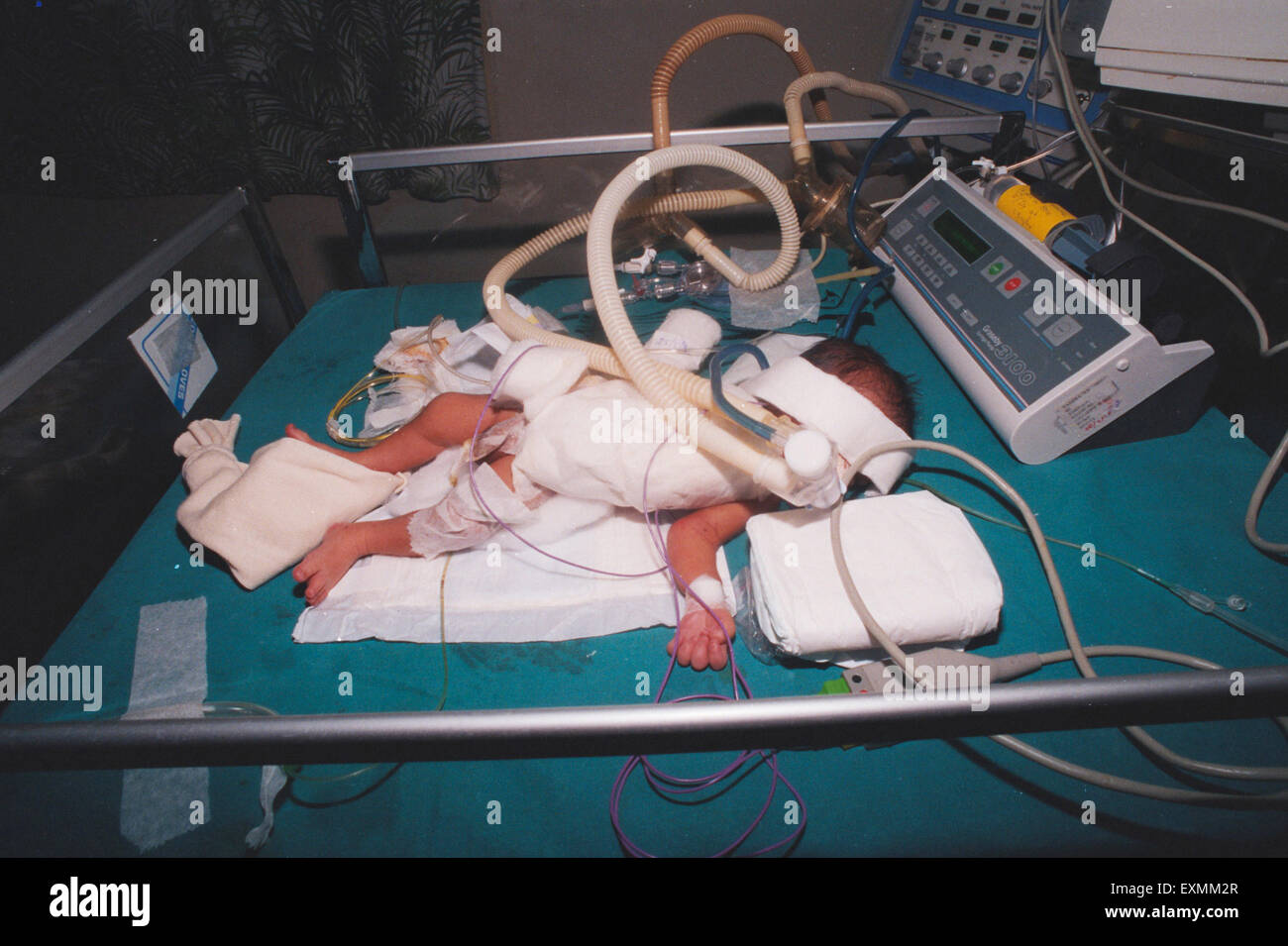 Baby with two hearts in hospital incubator, Bombay, Mumbai, Maharashtra, India, Asia Stock Photo