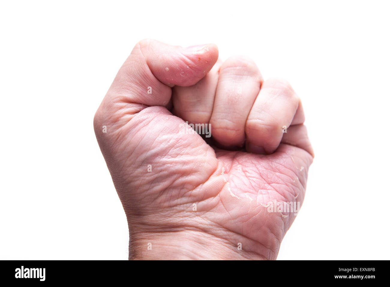 Eczema Dermatitis on Back of Hand and Fingers Stock Photo