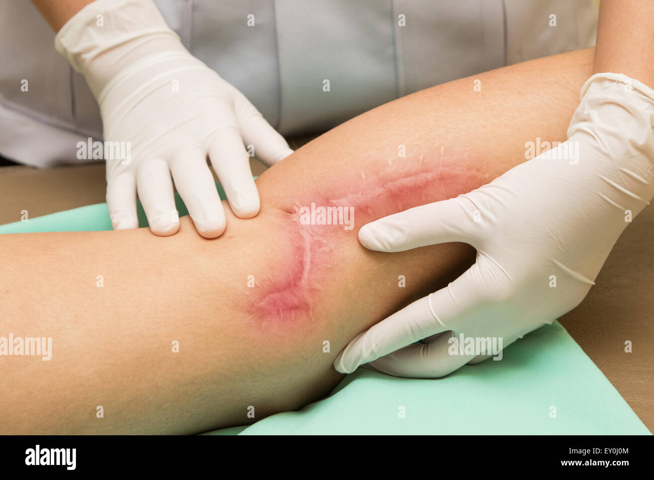 Wound scar on leg after surgery Stock Photo